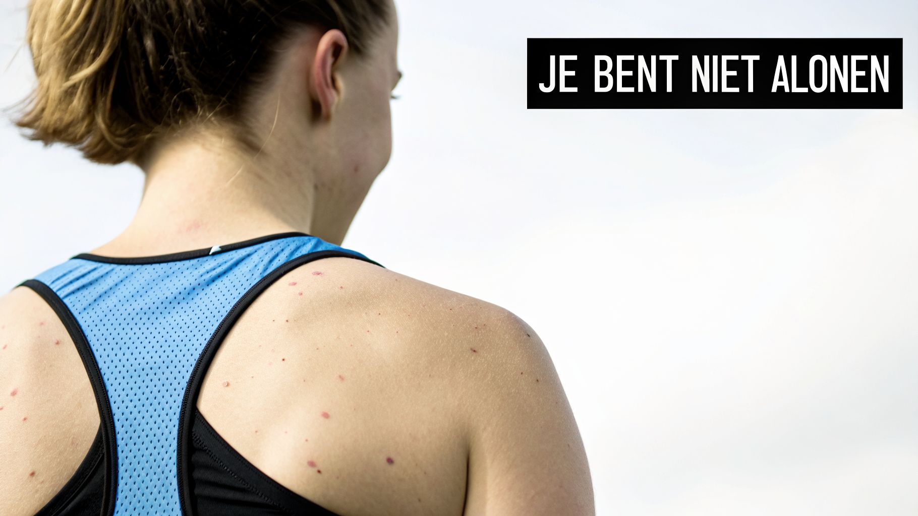 Rug van een vrouw met puistjes, draagt een blauwe sporttop. Tekst: 'JE BENT NIET ALONEN'.