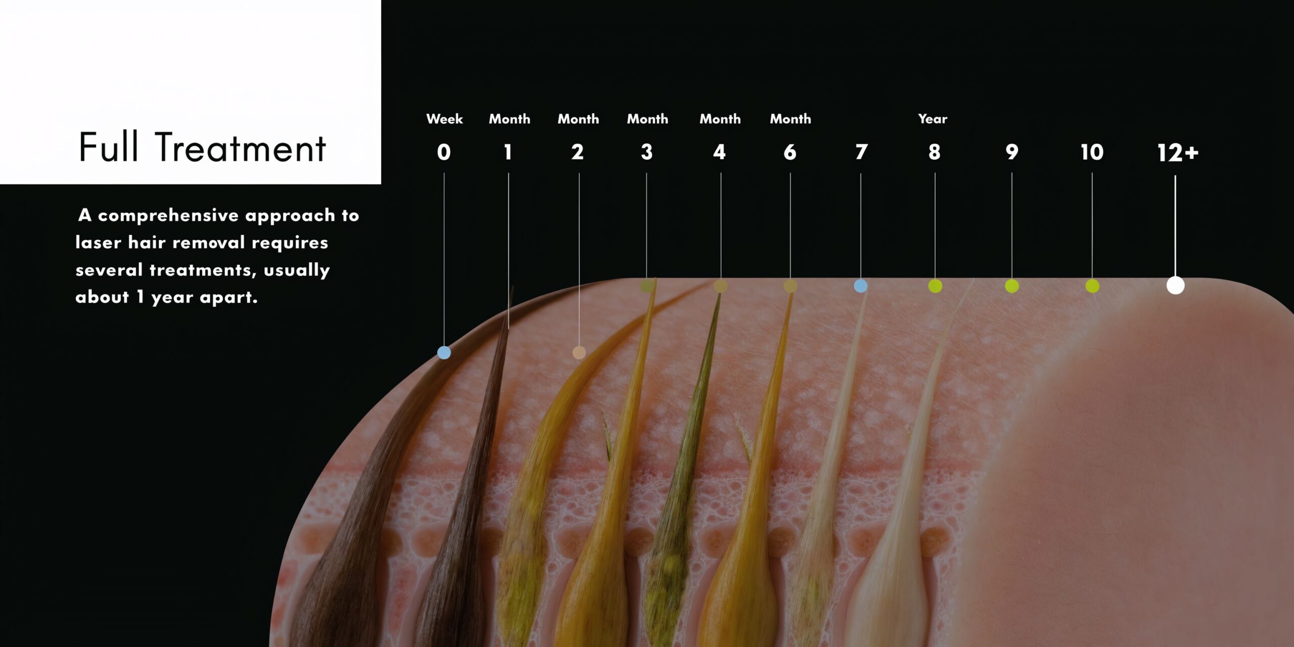 Een tijdlijn die de geleidelijke vermindering van lichaamshaar toont na een volledige laserontharingsbehandeling gedurende twaalf maanden.
