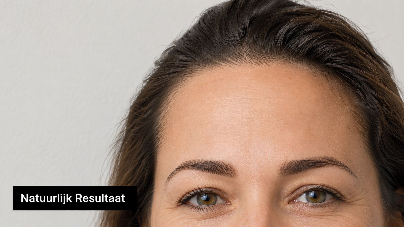 Een close-up van een vrouwelijk voorhoofd met een natuurlijk resultaat na een cosmetische behandeling tegen rimpels.