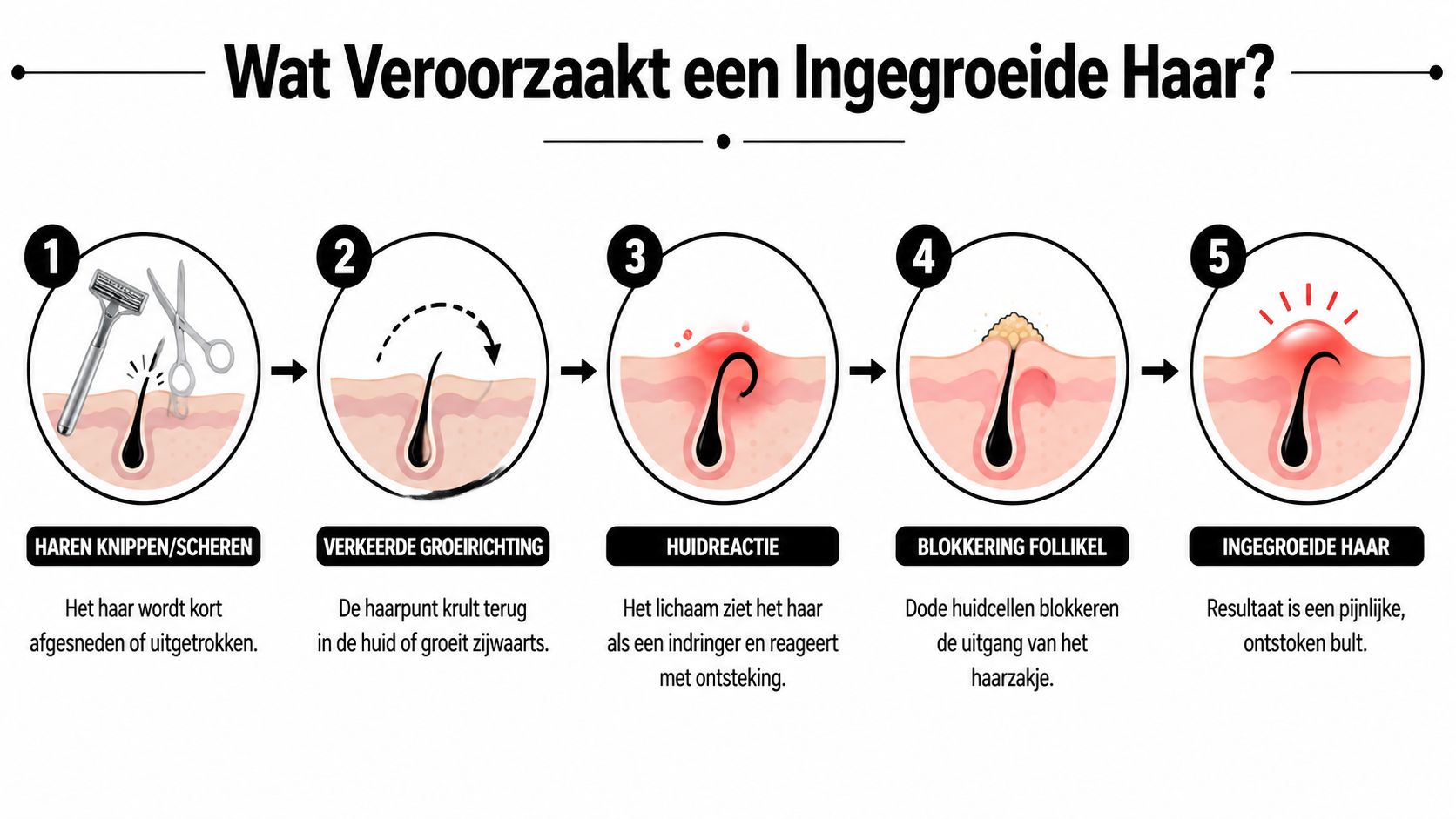 Een infographic die de vijf stappen toont van het ontstaan van een pijnlijke ingegroeide haar in de huid.