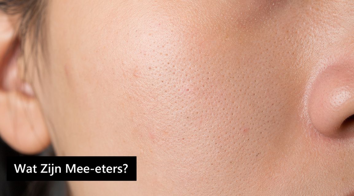 Close-up van een gezicht met zichtbare poriën en mee-eters op de wangen en neus van een persoon.