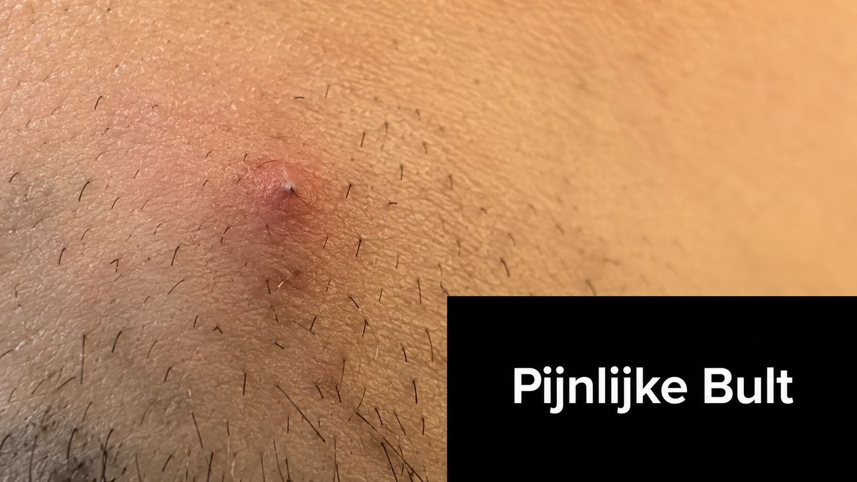 Close-up van een pijnlijke, ontstoken bult op de huid, mogelijk veroorzaakt door een ingegroeide haar.