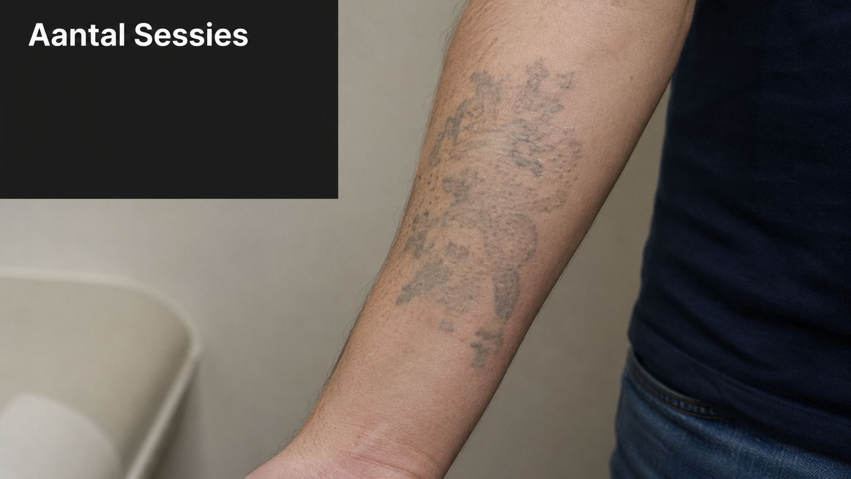 Een vervaagde tatoeage op de onderarm van een persoon tijdens een proces van tatoeageverwijdering.