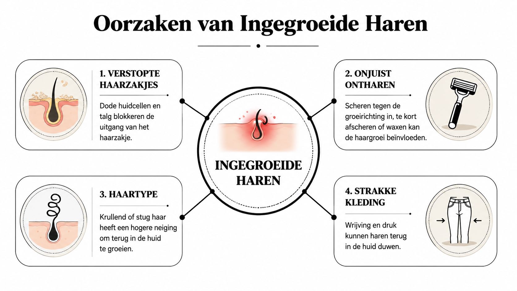 Een informatieve afbeelding over de vier belangrijkste oorzaken van ingegroeide haren, weergegeven met duidelijke illustraties en uitleg.