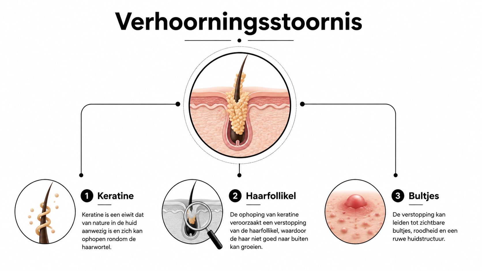 Een infographic die de biologische oorzaak en het proces van keratosis pilaris in de huid verklaart.