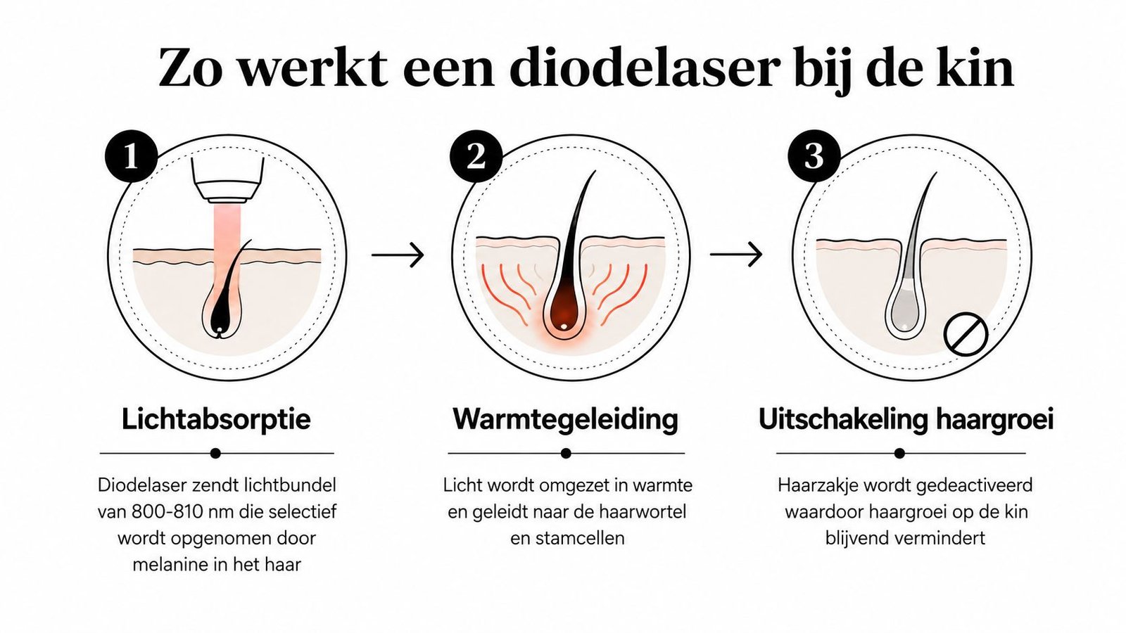 Een infographic die in drie stappen uitlegt hoe een diodelaser haar op de kin permanent verwijdert.